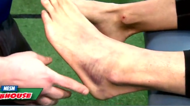 The Baseball Lab: How To Treat A Sprained Ankle